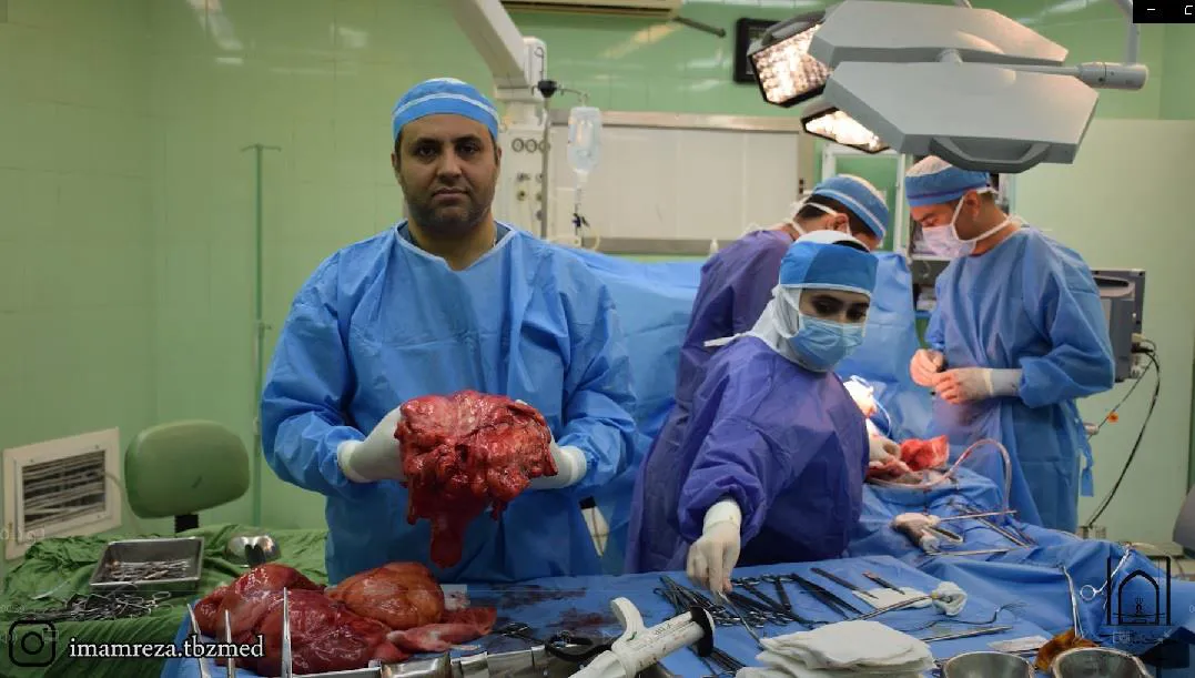  خارج کردن توده بیست کیلویی از شکم یک مرد 65 ساله در مرکز امام رضا(ع) تبریز